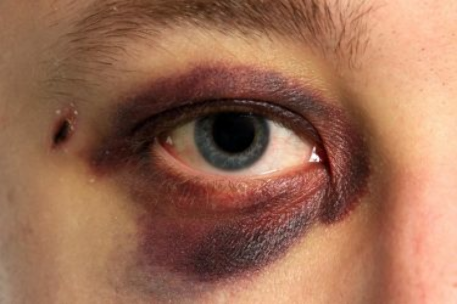 Blood splatter transparent dripping eye. Injuries treatment of ocular