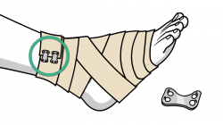 How to Treat and Wrap a Sprained Ankle: Expert First Aid Guide