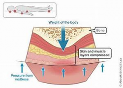 Skin Ulcer Diagram. anatomy and normal microbiota of the ...