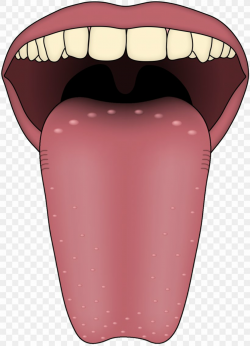 Tongue Transient Lingual Papillitis Taste Bud Lingual ...
