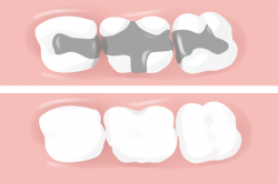 My New Composite (Tooth-Colored) Restoration | DentFirst ...